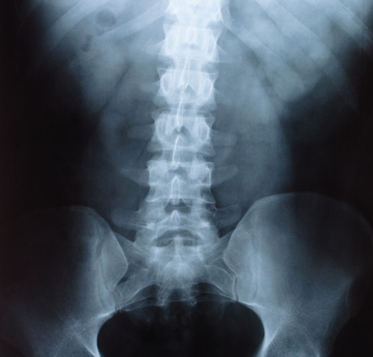Normal Abdominal X-Ray